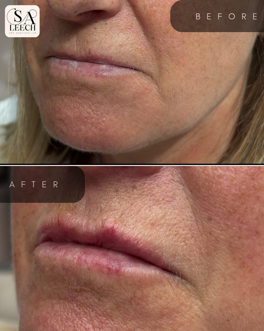 Lip filler before and after