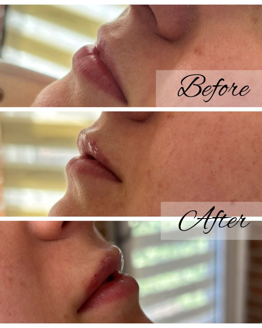 Lip filler before and after, side profile