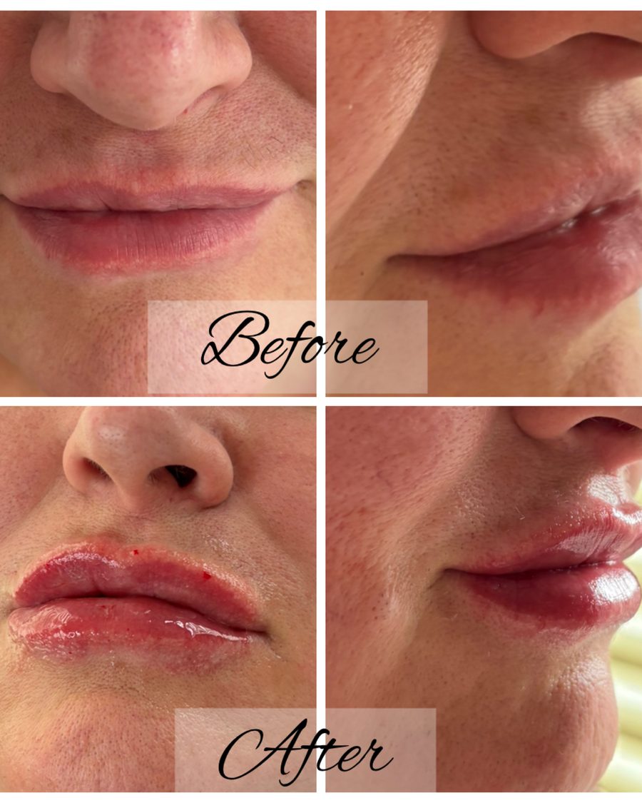 Lip filler before and after