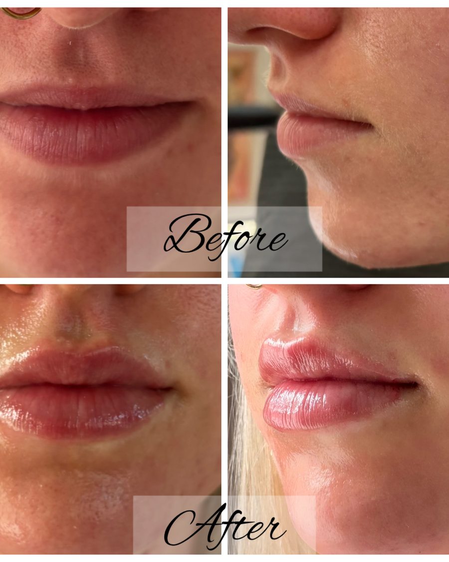 Lip filler before and after