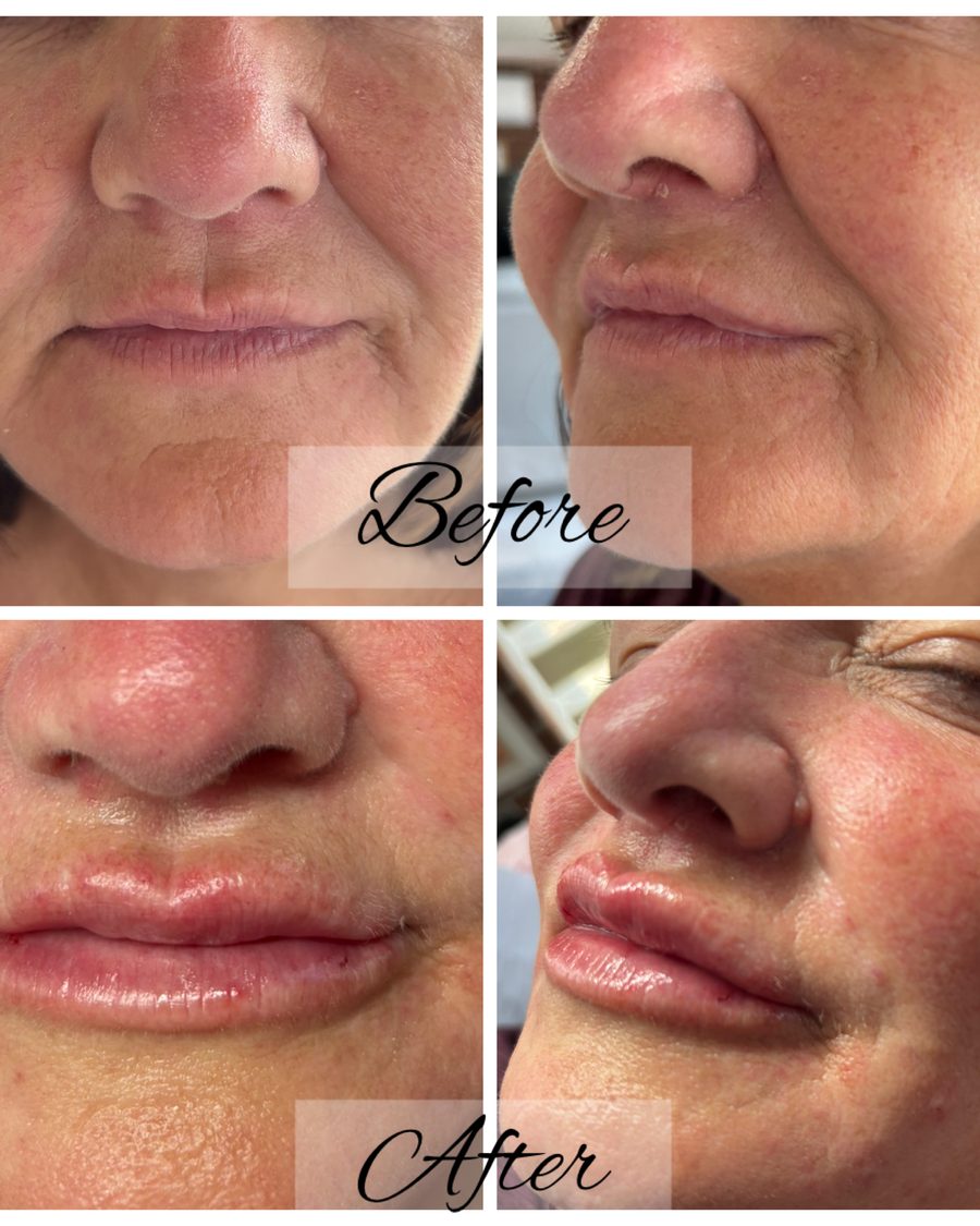 Lip dermal filler before and after