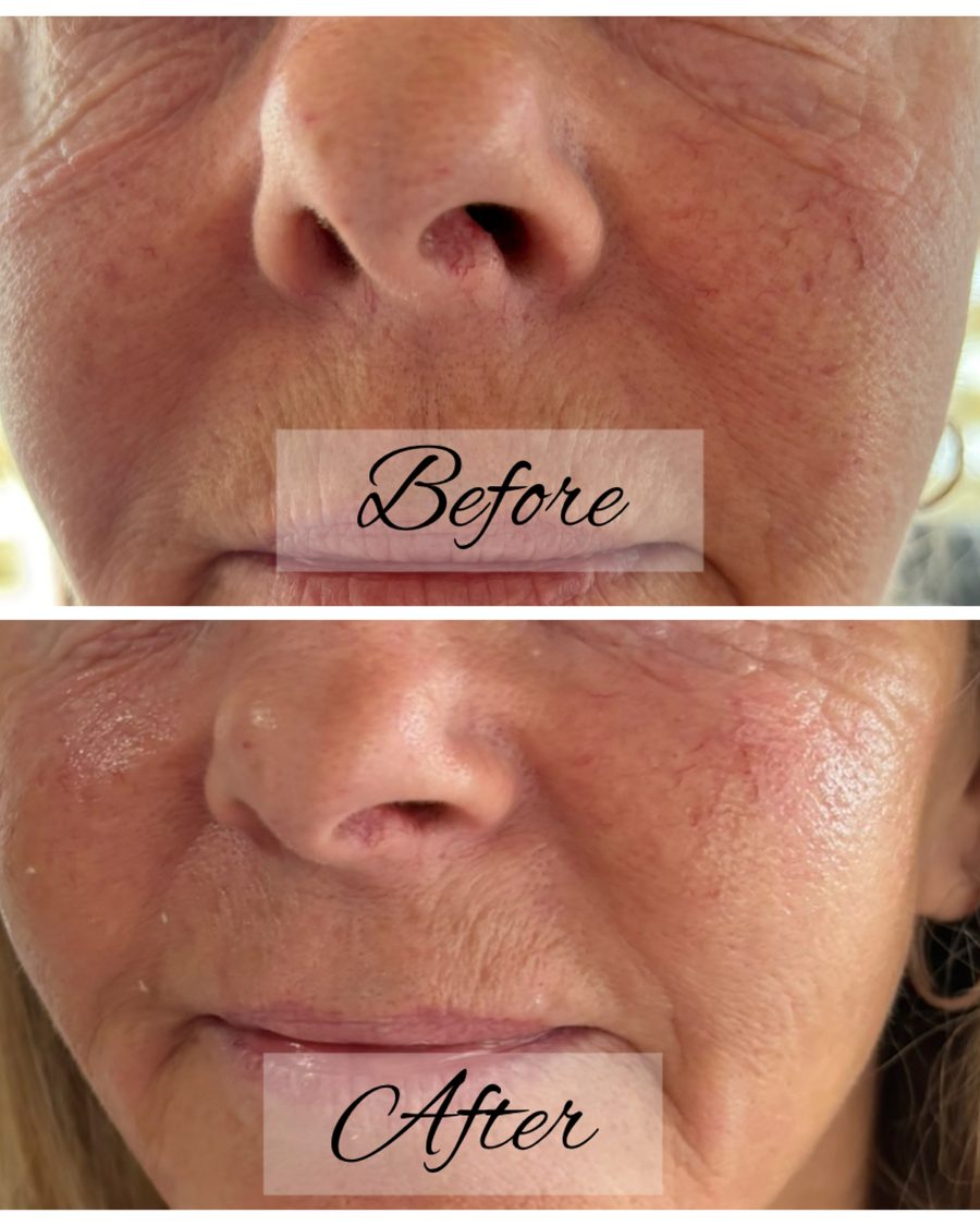 Cheek dermal filler before and after