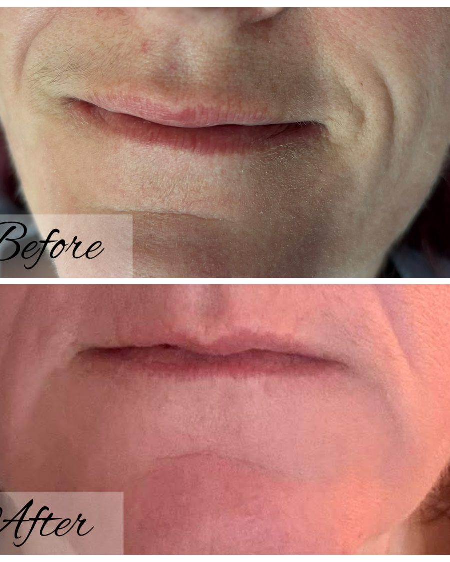 Lip filler before and after