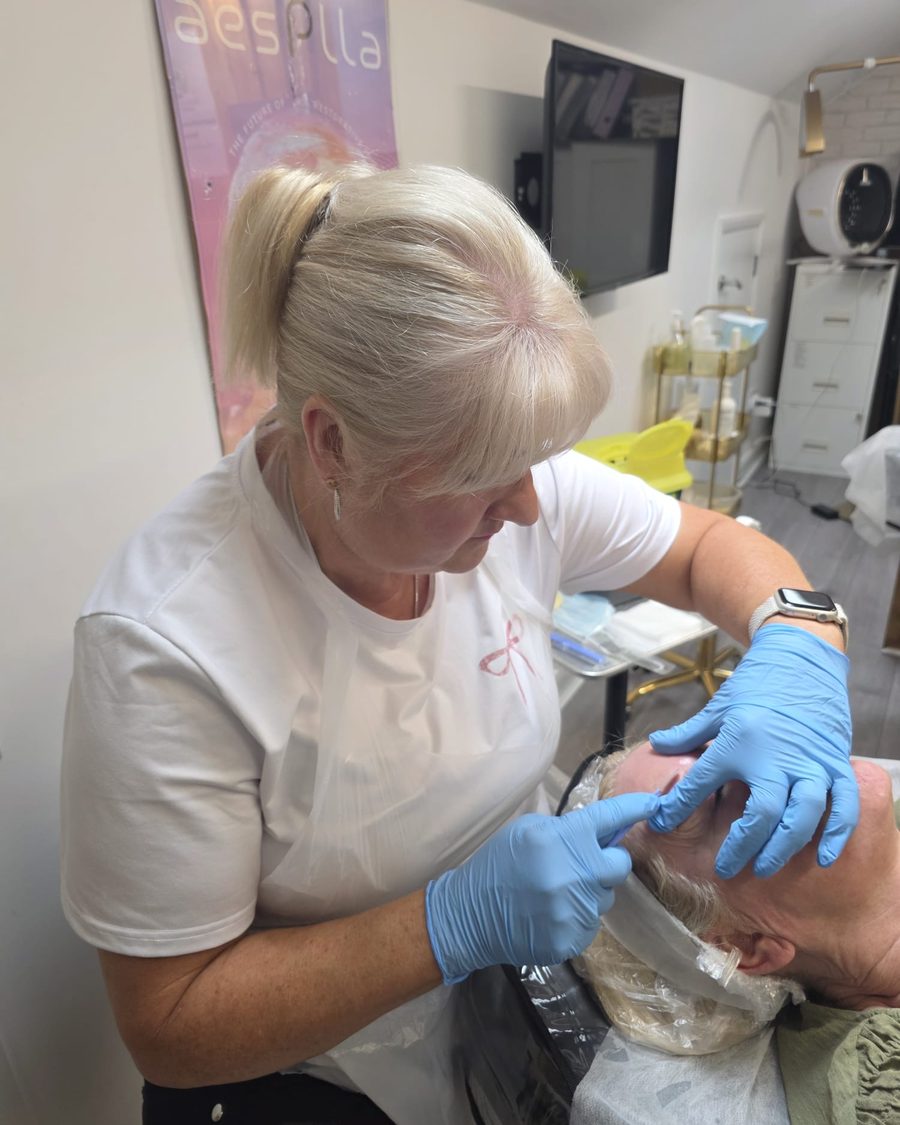 Microneedling treatment being administered