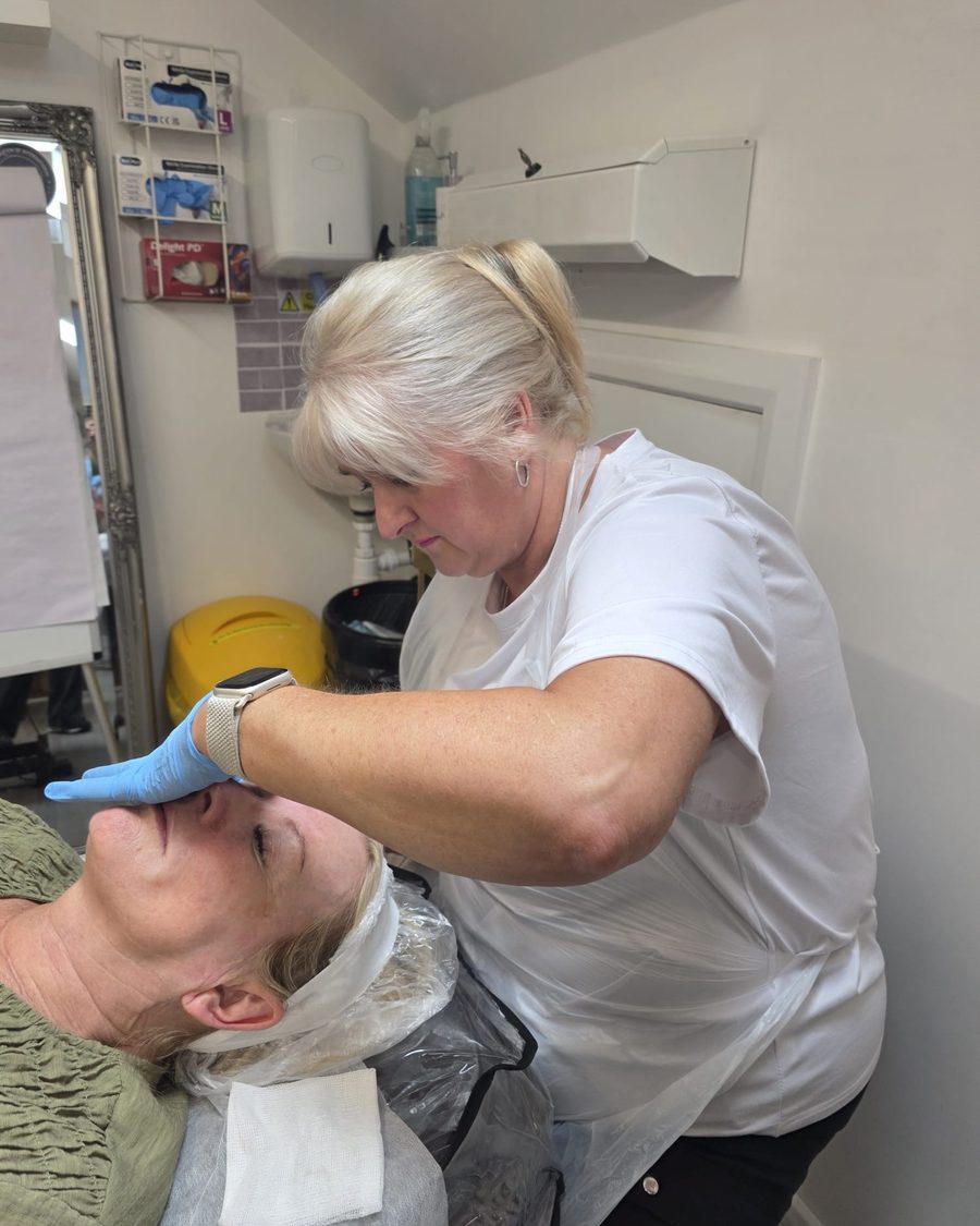 Microneedling treatment being administered