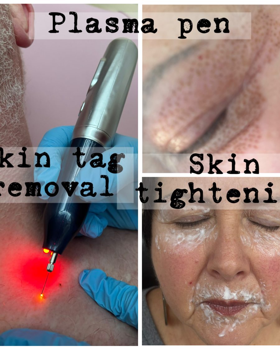 Plasma pen skin tightening and skin tag removal