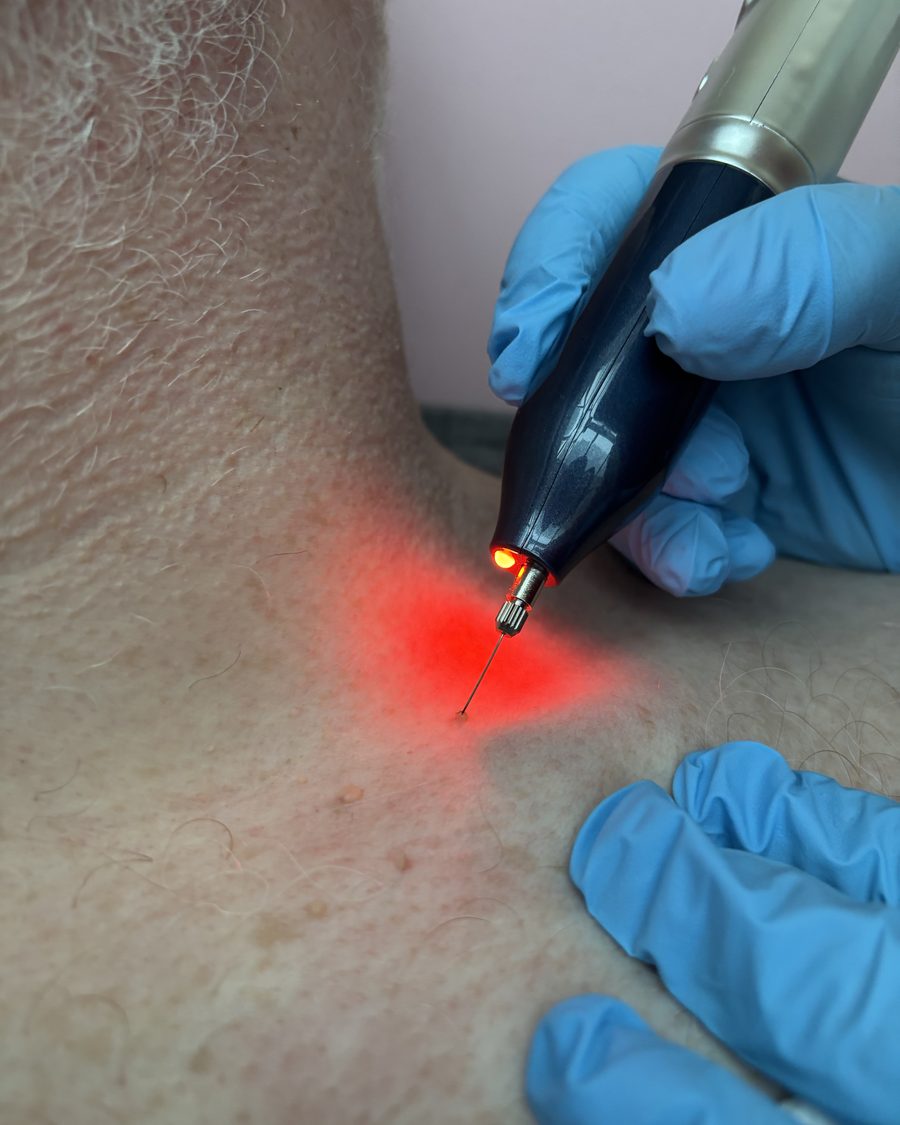 Skin tag removal using plasma pen
