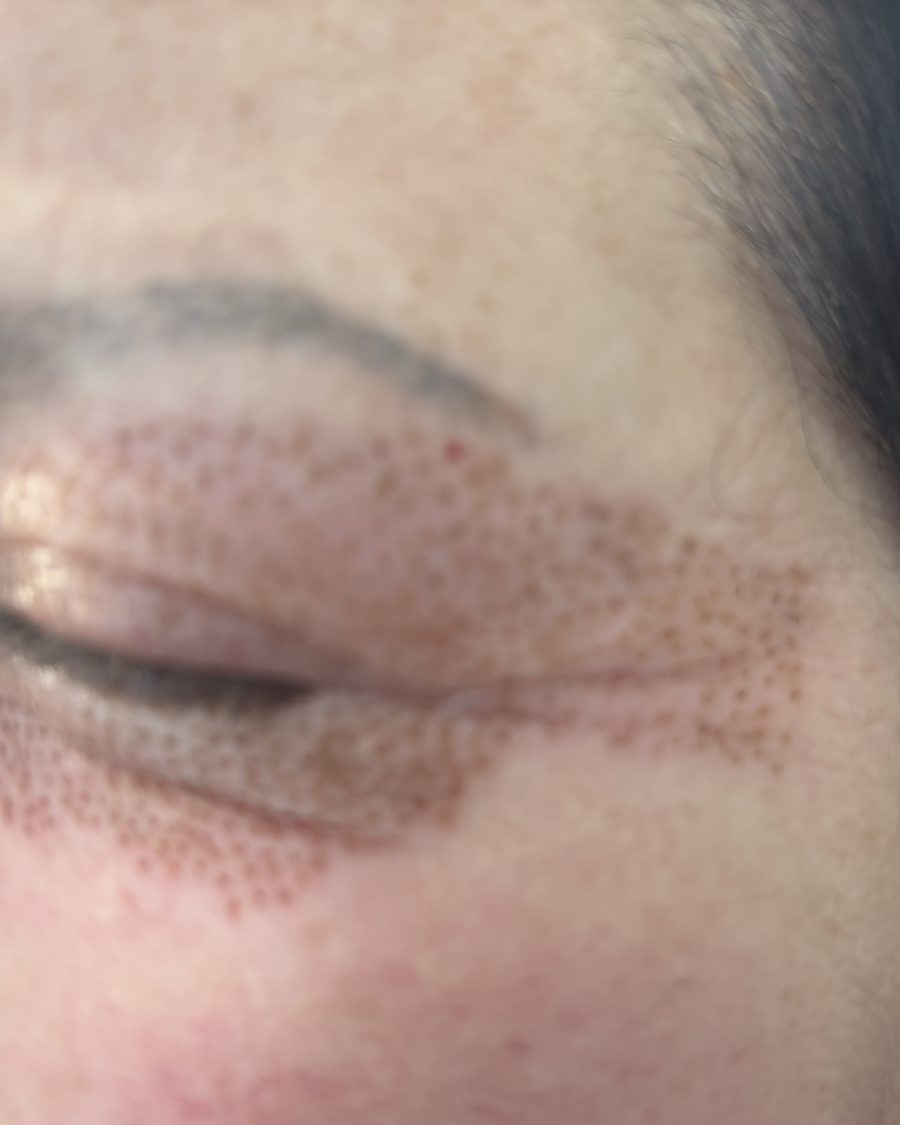 Skin healing after plasma pen treatment