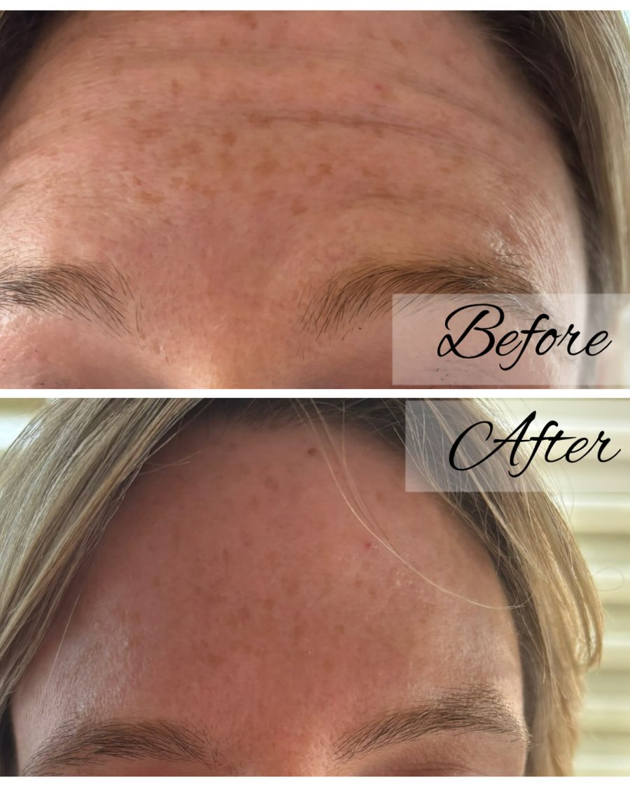 Anti-wrinkle treatment, forehead before and after