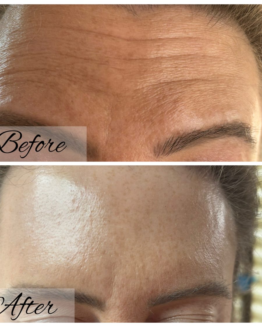 Anti-wrinkle treatment, forehead before and after