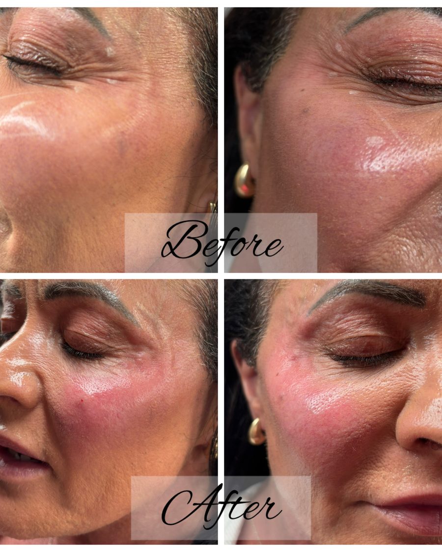 Cheek dermal filler before and after