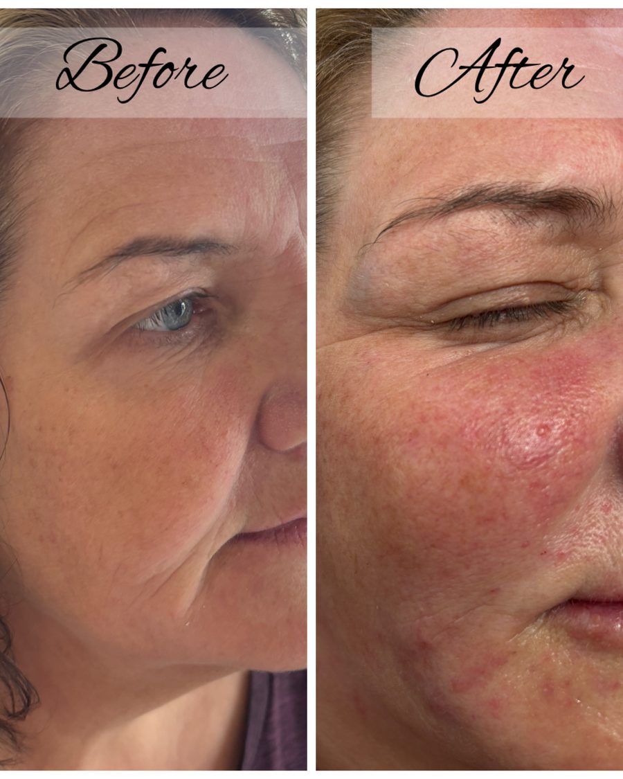 Cheek dermal filler before and after