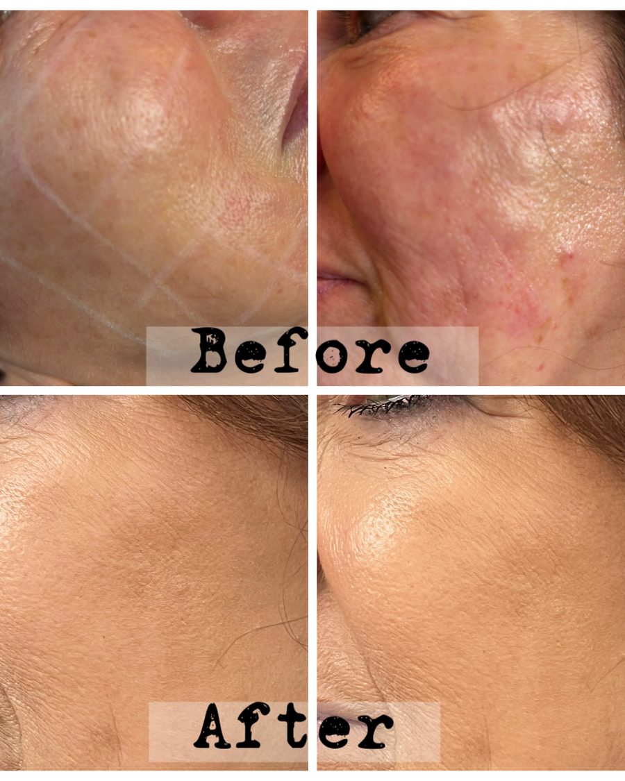 Polynucleotide treatment, cheek before and after