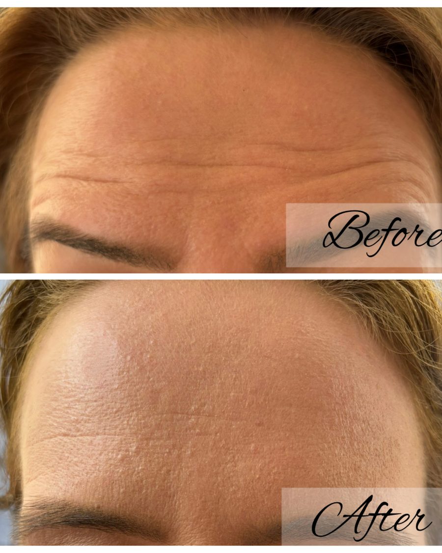 Anti-wrinkle treatment, forehead lines before and after