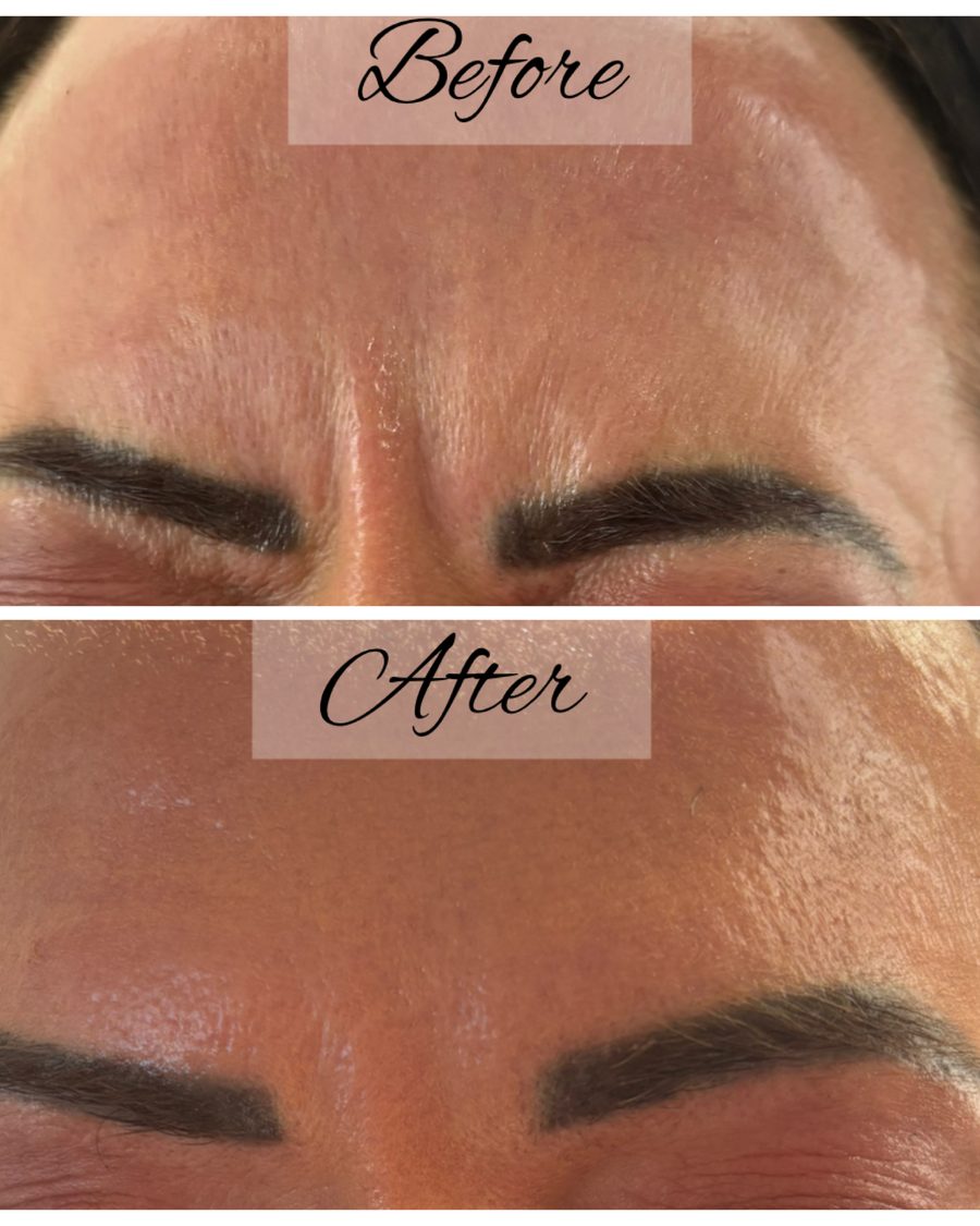 Anti-wrinkle treatment, brow before and after