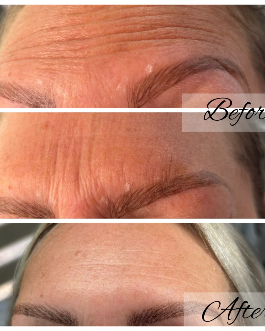 Anti-wrinkle treatment, forehead lines before and after