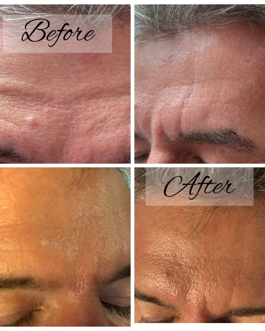 Anti-wrinkle treatment before and after