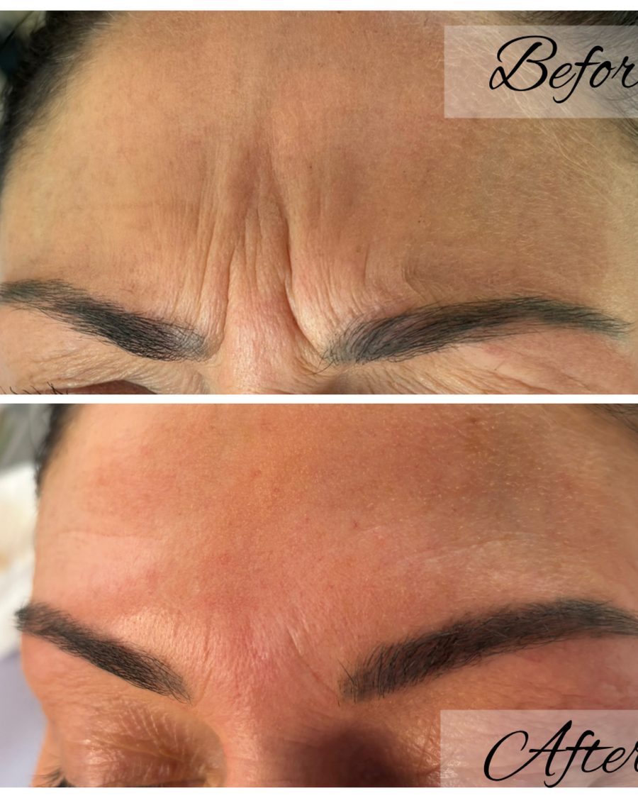 Anti-wrinkle treatment, forehead lines before and after