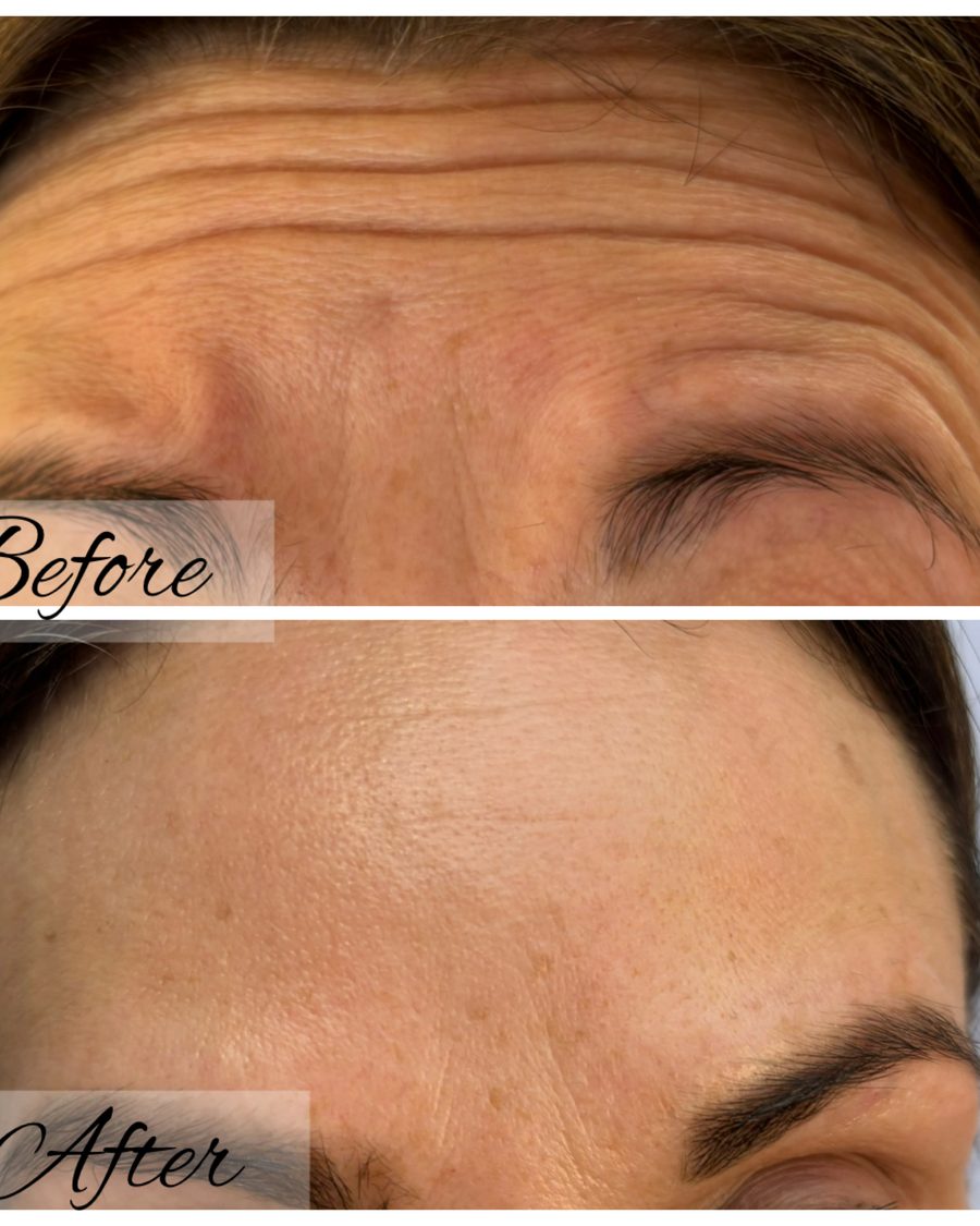 Anti-wrinkle treatment, forehead lines before and after