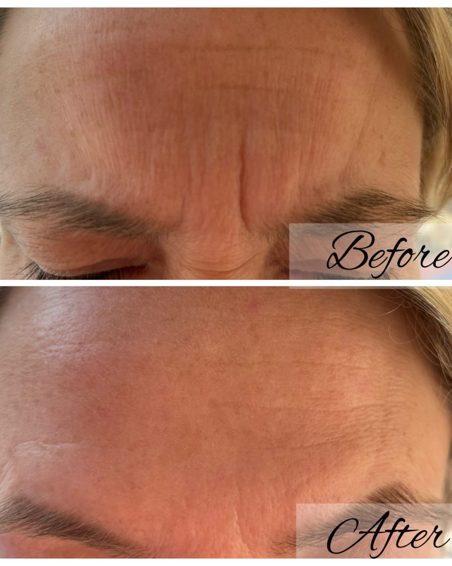 Anti-wrinkle treatment, forehead lines before and after